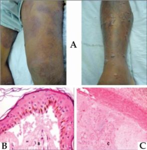 A) Pictures of skin lesions, multiple tense bullae and intense edema, with about twelve hours of evolution. Histopathological findings from leg and spleen. (B) Presence of gram-negative bacilli in the subepidermal space. (C) Presence of gram-negative bacilli inside the splenic small vessels. (H&E, 400X). Was later identified as Vibrio vulnificus. França et al., 2013