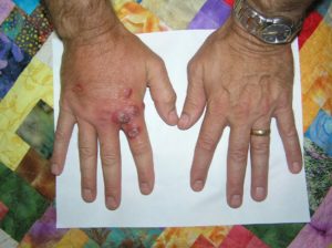 The hands of Jim Craig in 2009 after cleaning Palythoas off of a shelf in a frag tank. More here.