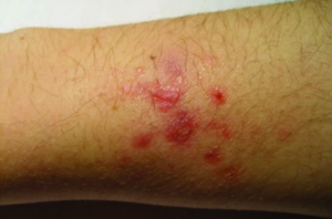 Mycobacterium marinum infection of the arm of a fish-tank worker. Piersimoni and Scarparo 2009.