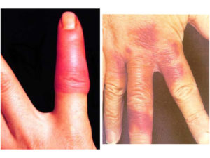 Erysipelothrix rhusiopathiae. Left: purplish red, indurated skin lesions on fingers or hands. Right: treated with penicillin